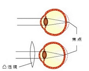 近视矫正原理